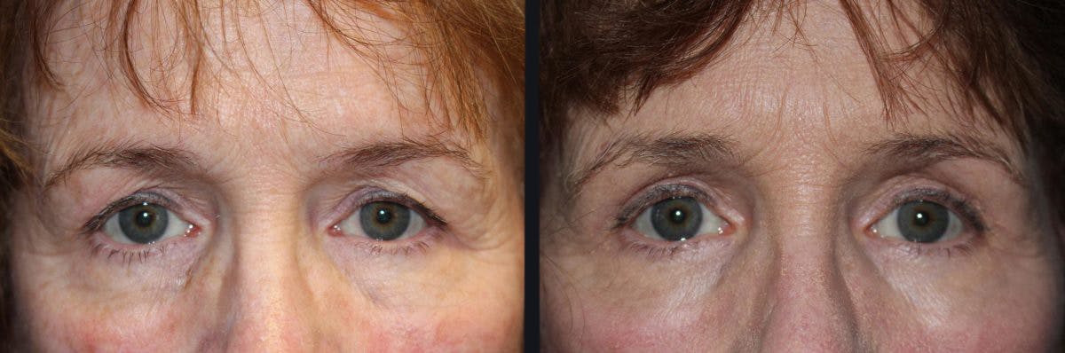 Blepharoplasty Before & After Gallery - Patient 177905815 - Image 1