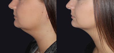 Neck Liposuction Before & After Gallery - Patient 177905816 - Image 1