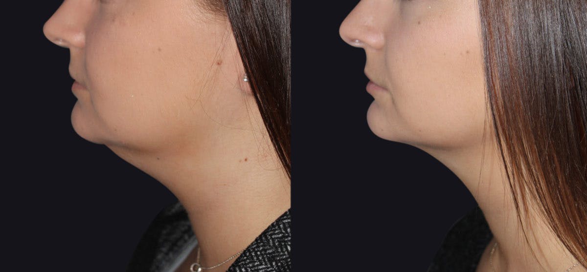 Neck Liposuction Before & After Gallery - Patient 177905816 - Image 1