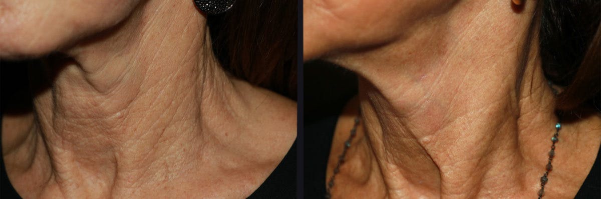 Neck Rejuvenation Before & After Gallery - Patient 177905802 - Image 2