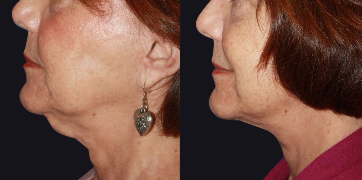 Neck Lift Before & After Gallery - Patient 177905801 - Image 1