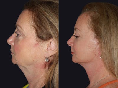 Facelift Before & After Gallery - Patient 177905800 - Image 1