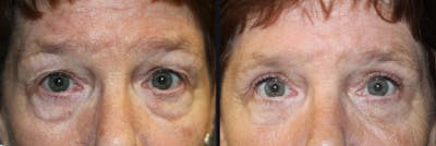 Blepharoplasty Before & After Gallery - Patient 177905795 - Image 1