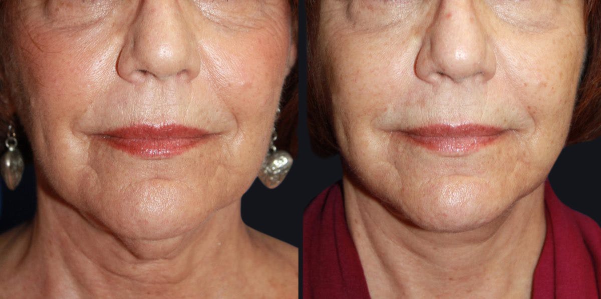 Neck Lift Before & After Gallery - Patient 177905801 - Image 2