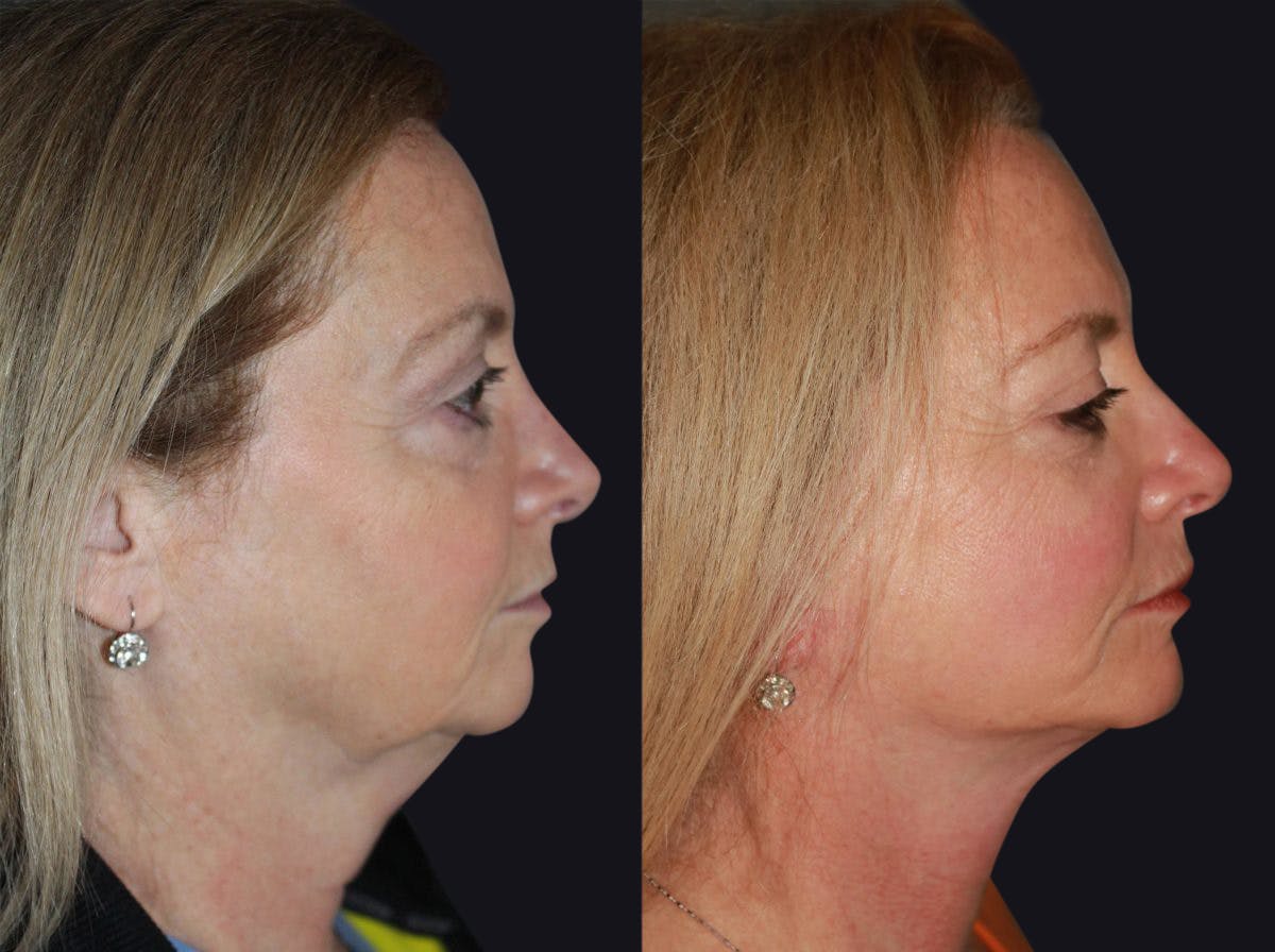 Facelift Before & After Gallery - Patient 177905800 - Image 3