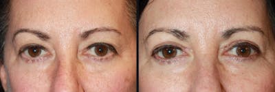 Blepharoplasty Before & After Gallery - Patient 177905775 - Image 1