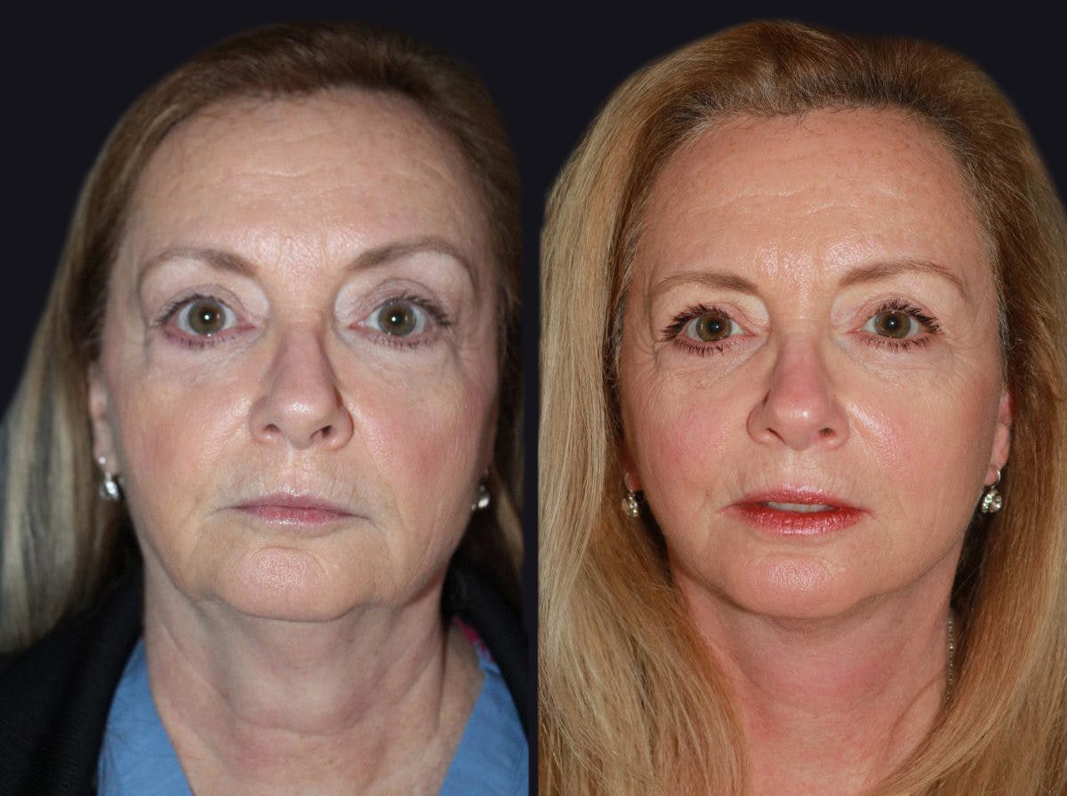 Facelift Before & After Gallery - Patient 177905800 - Image 2