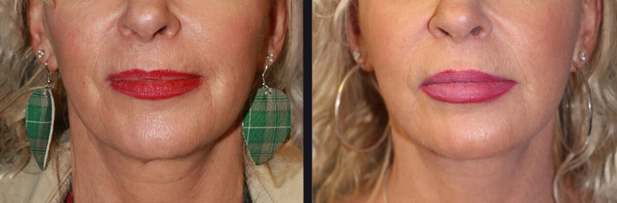 Neck Lift Before & After Gallery - Patient 177905774 - Image 2