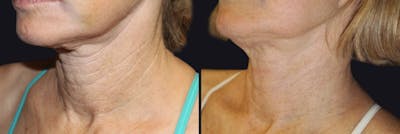 Neck Rejuvenation Before & After Gallery - Patient 177905772 - Image 1