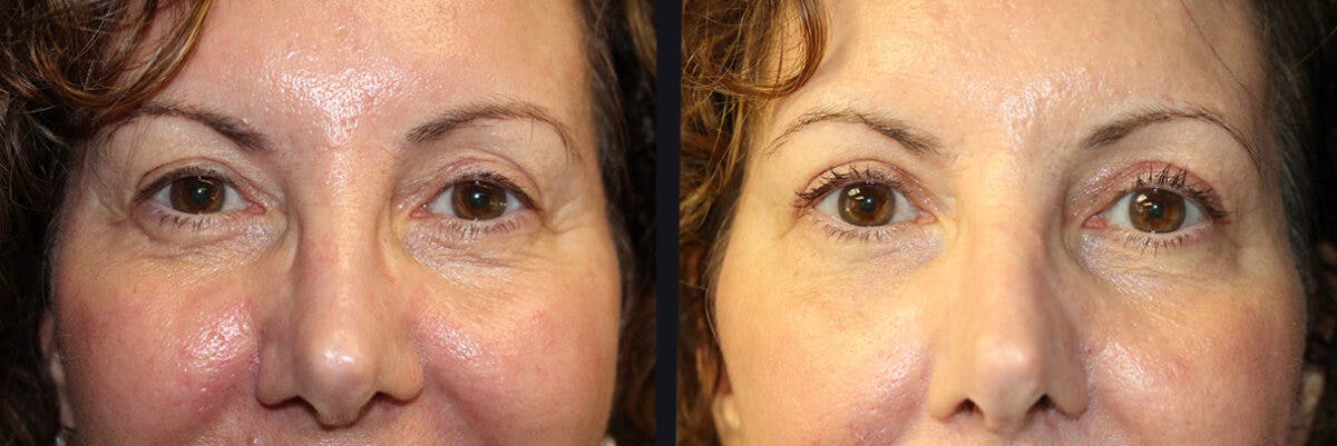 Blepharoplasty Before & After Gallery - Patient 177905754 - Image 1
