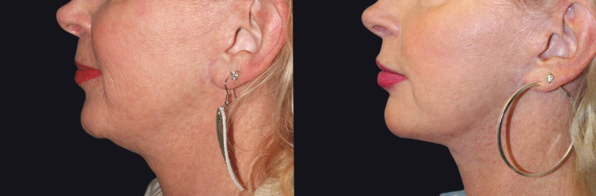 Neck Lift Before & After Gallery - Patient 177905774 - Image 1