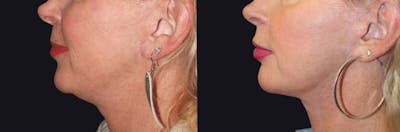 Neck Lift Before & After Gallery - Patient 177905774 - Image 1