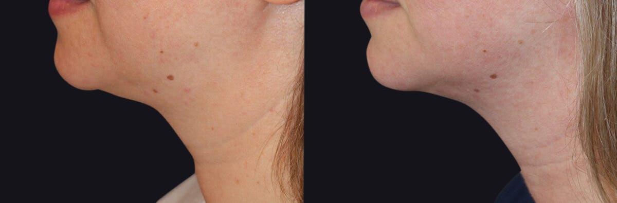 Neck Rejuvenation Before & After Gallery - Patient 177905751 - Image 2