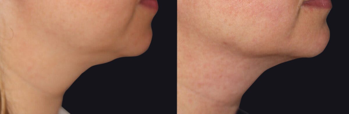 Neck Rejuvenation Before & After Gallery - Patient 177905751 - Image 1