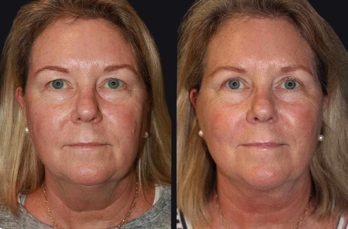 Facelift Before & After Gallery - Patient 177905747 - Image 2