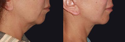 Neck Lift Before & After Gallery - Patient 177905737 - Image 1