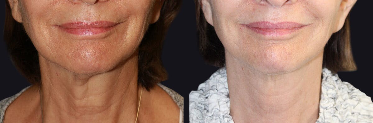 Neck Rejuvenation Before & After Gallery - Patient 177905718 - Image 1