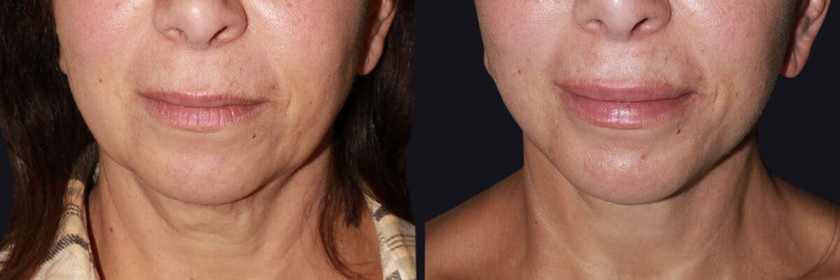 Neck Lift Before & After Gallery - Patient 177905737 - Image 2