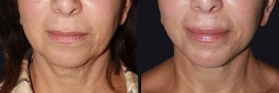 Neck Lift Before & After Gallery - Patient 177905737 - Image 1