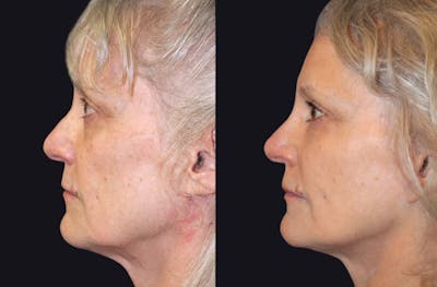 Facelift Before & After Gallery - Patient 177905695 - Image 1