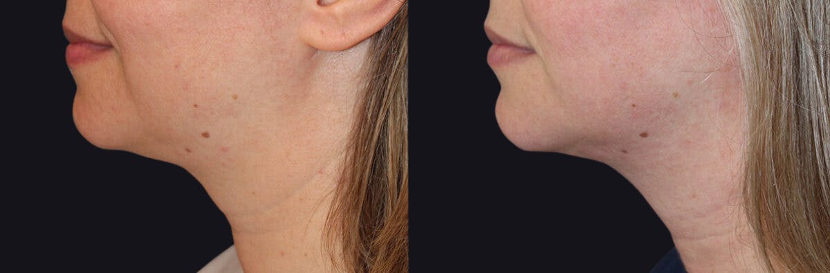 Neck Rejuvenation Before & After Gallery - Patient 177905688 - Image 2