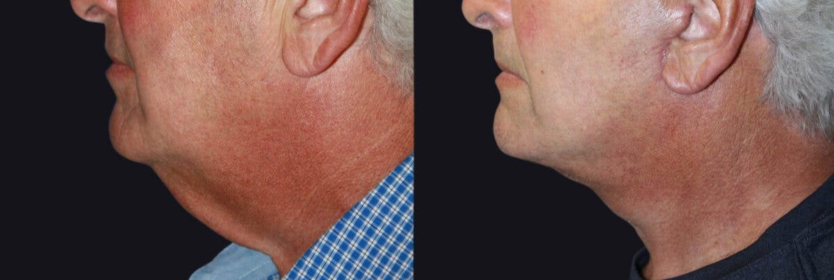Neck Lift Before & After Gallery - Patient 177905683 - Image 1