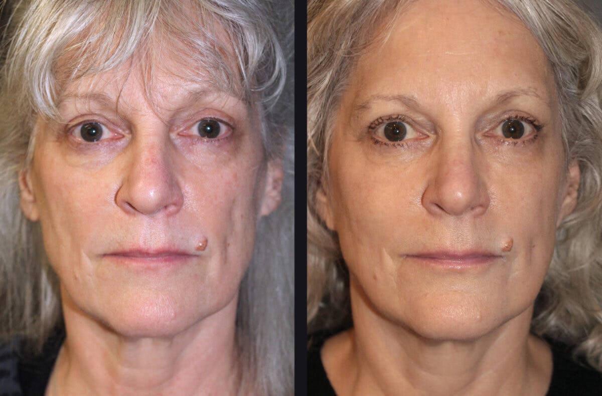 Facelift Before & After Gallery - Patient 177905695 - Image 2