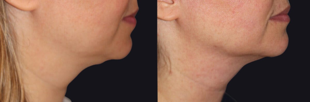 Neck Rejuvenation Before & After Gallery - Patient 177905688 - Image 1