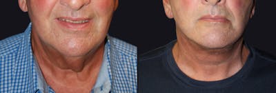 Neck Lift Before & After Gallery - Patient 177905683 - Image 1