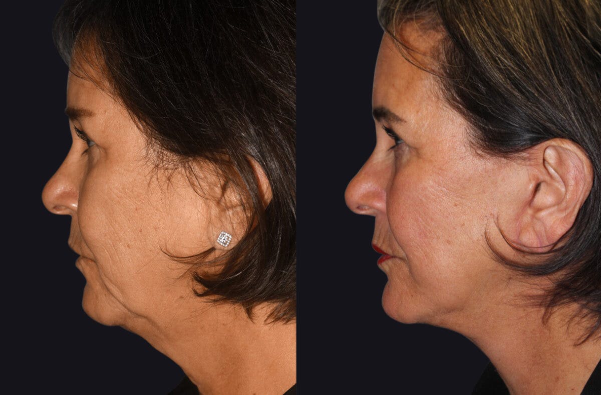 Facelift Before & After Gallery - Patient 177905640 - Image 2