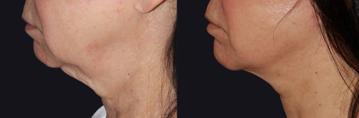 Neck Lift Before & After Gallery - Patient 177905616 - Image 1