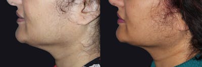 Profound Before & After Gallery - Patient 264945 - Image 1