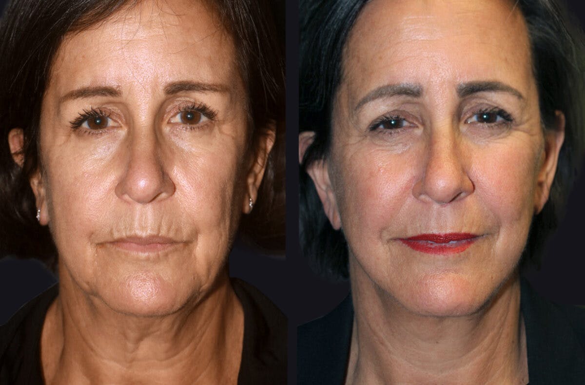 Facelift Before & After Gallery - Patient 177905640 - Image 2