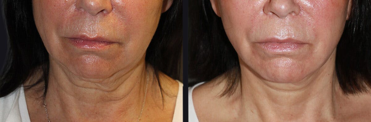 Neck Lift Before & After Gallery - Patient 177905616 - Image 2