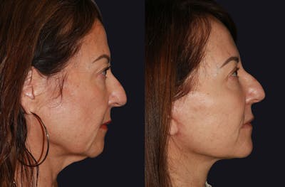 Facelift Before & After Gallery - Patient 177905512 - Image 1