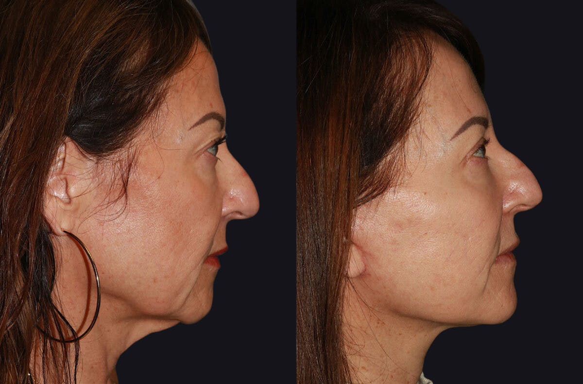Facelift Before & After Gallery - Patient 177905512 - Image 2