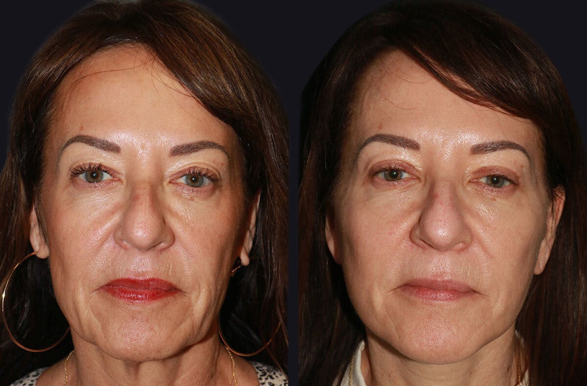 Facelift Before & After Gallery - Patient 177905512 - Image 2