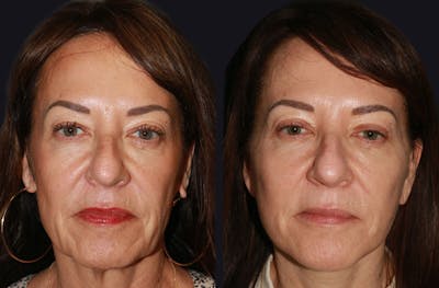 Facelift Before & After Gallery - Patient 177905512 - Image 1