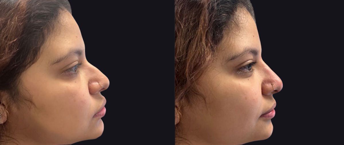 Non Surgical Rhinoplasty Before & After Gallery - Patient 110762 - Image 1