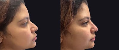 Non Surgical Rhinoplasty Before & After Gallery - Patient 110762 - Image 1