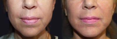 Microneedling Before & After Gallery - Patient 177905350 - Image 1