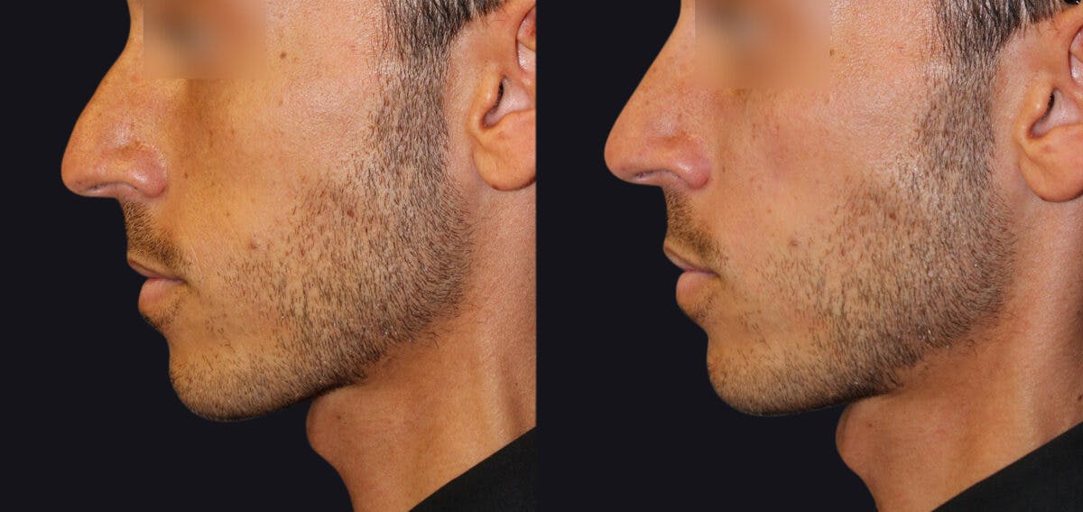 Non Surgical Rhinoplasty Before & After Gallery - Patient 177905342 - Image 1