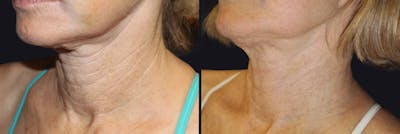 Microneedling Before & After Gallery - Patient 177905341 - Image 1