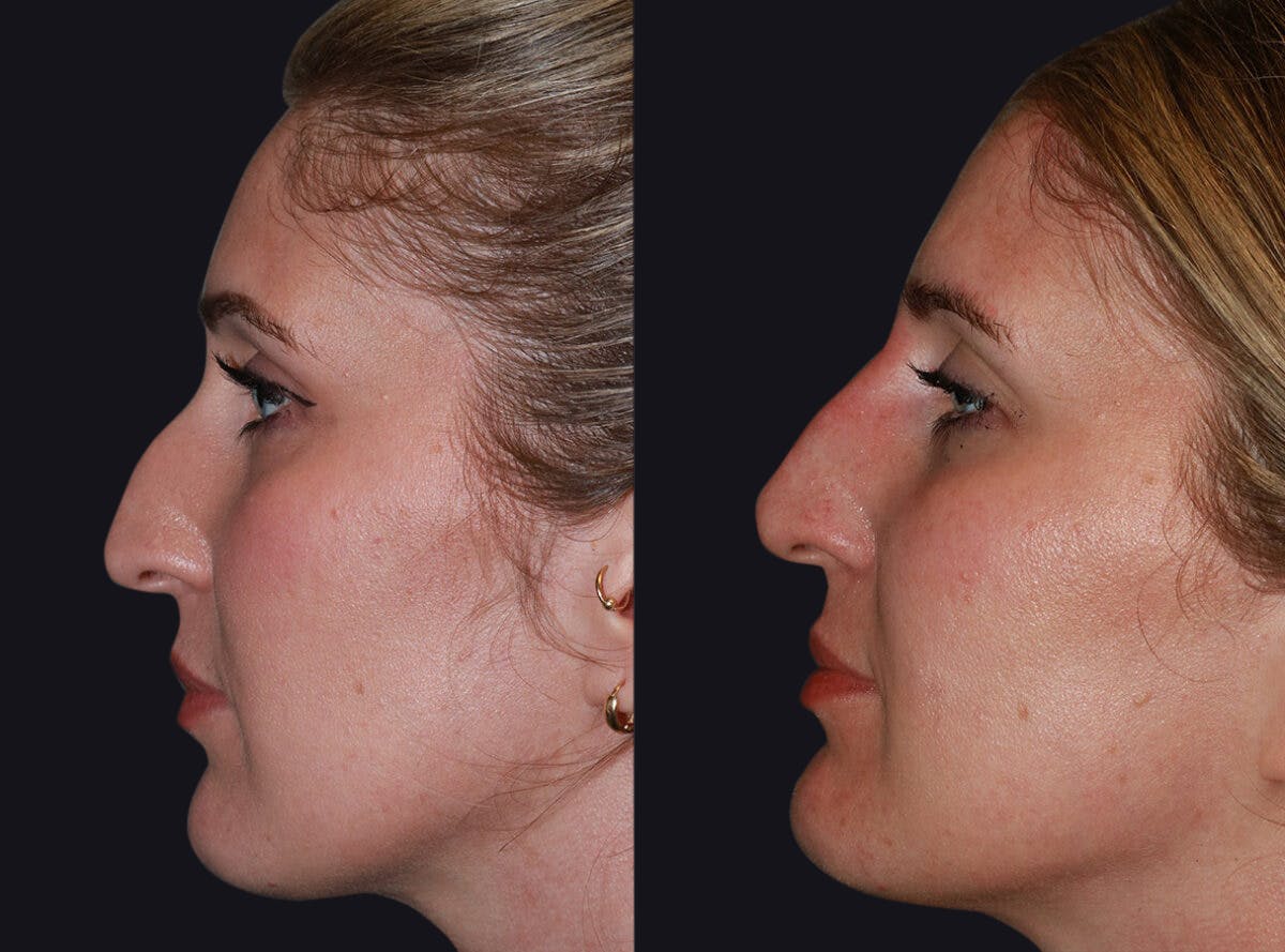 Non Surgical Rhinoplasty Before & After Gallery - Patient 177905339 - Image 3