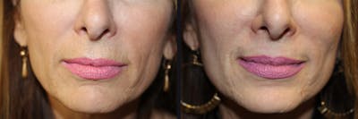 Microneedling Before & After Gallery - Patient 177905338 - Image 1
