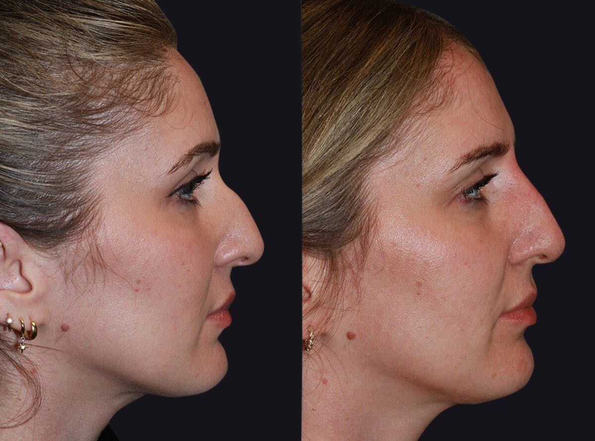 Non Surgical Rhinoplasty Before & After Gallery - Patient 177905339 - Image 2