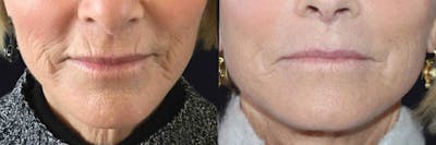 Microneedling Before & After Gallery - Patient 177905335 - Image 1
