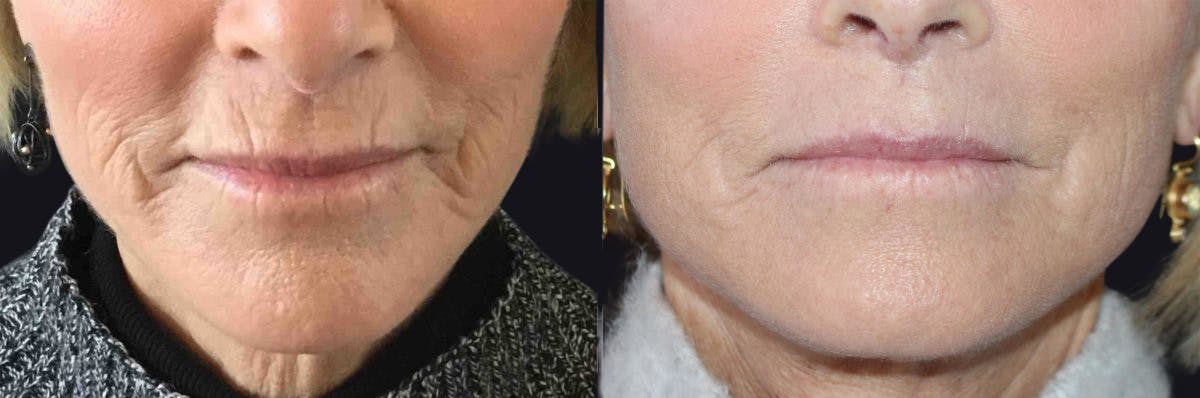 Microneedling Before & After Gallery - Patient 177905335 - Image 1