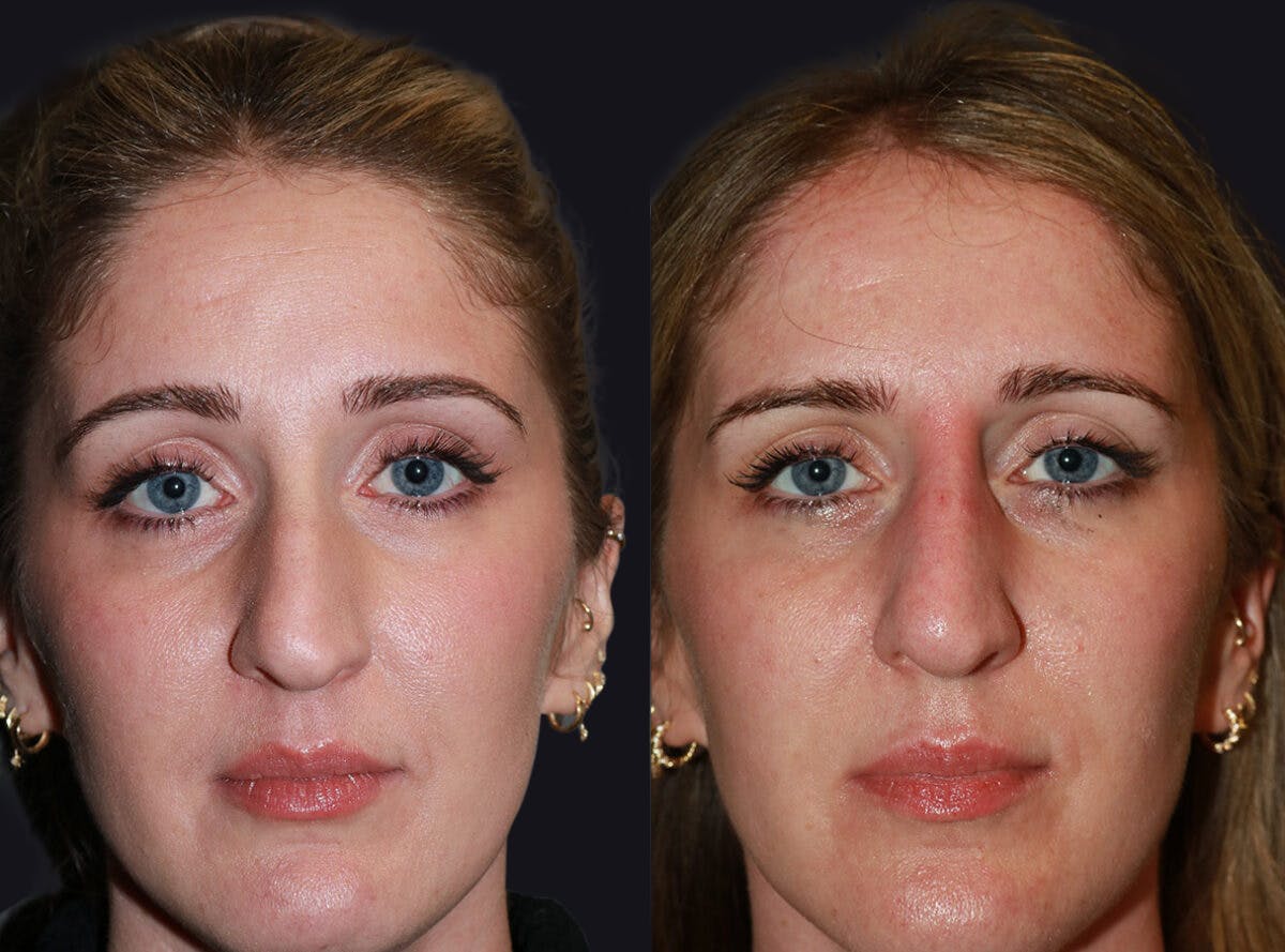 Non Surgical Rhinoplasty Before & After Gallery - Patient 177905339 - Image 1