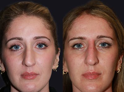 Non Surgical Rhinoplasty Before & After Gallery - Patient 177905339 - Image 1